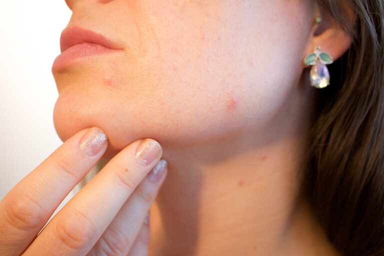 acne, brufoli sul viso